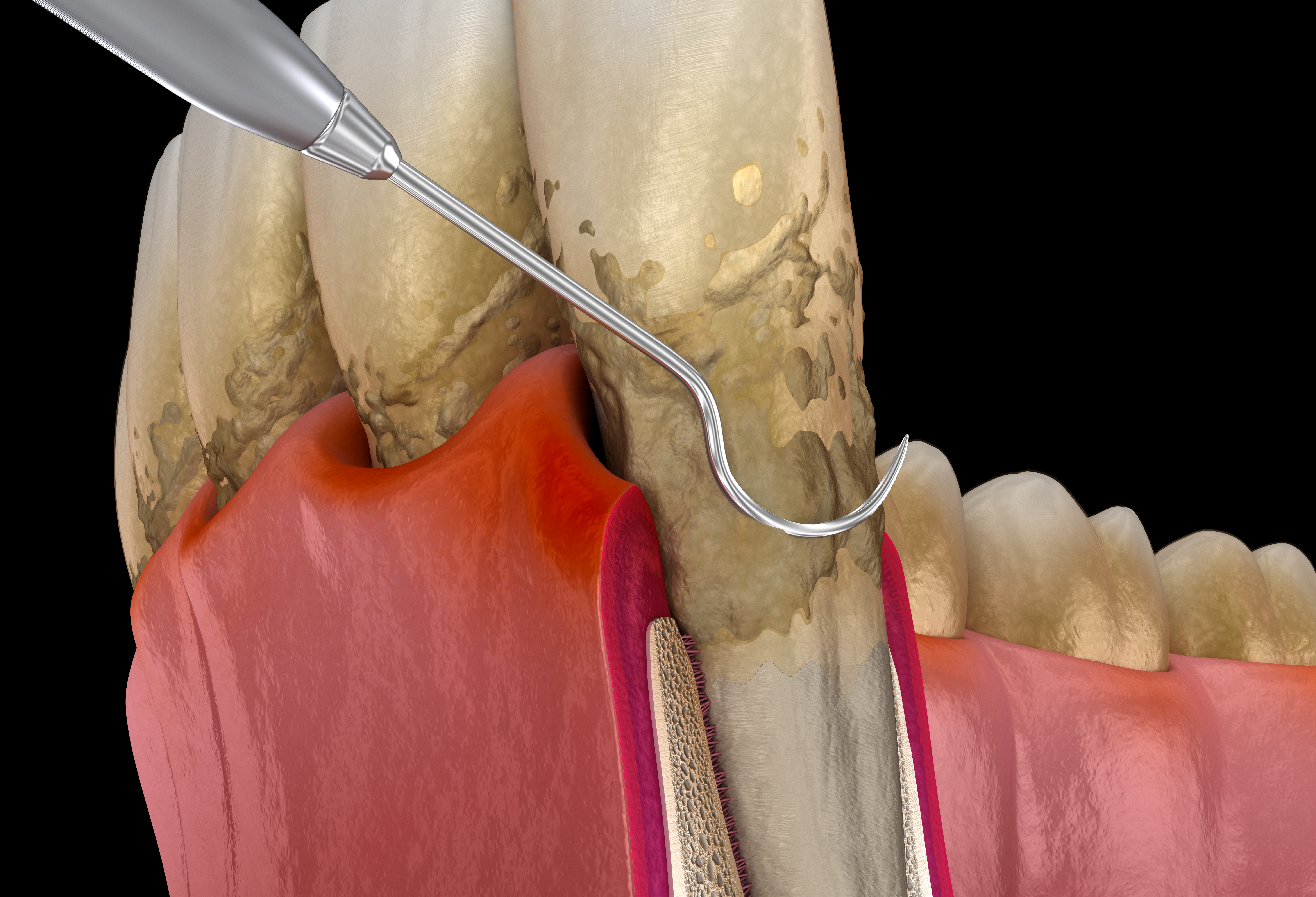 Gum Disease / Periodontal Treatment in New York