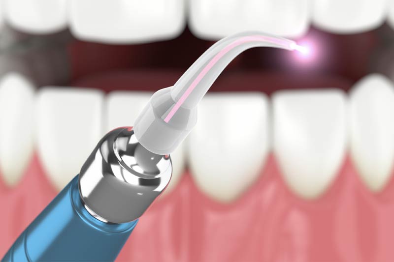 Laser Dentistry in New York
