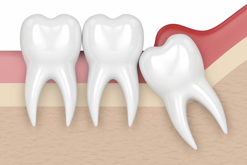 Wisdom Tooth Removal in New York